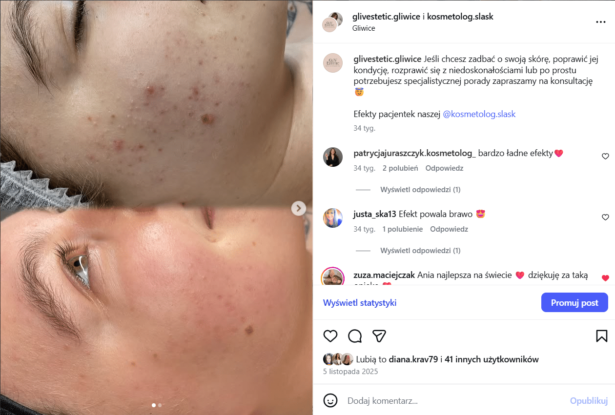 Sprawdź na naszym instagramie efekty terapii przeciwtrądzikowej!