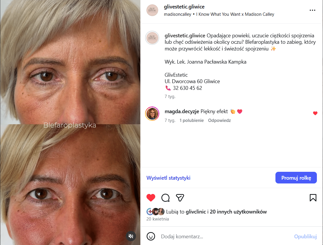 Odwiedź nasz instagram i sprawdź jakie efekty przynosi blefaroplastyka.